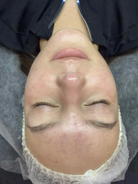 Po terapii łączonej